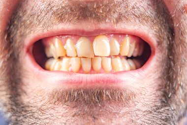 Eğri büğrü ısırık. Sakallı bir adamın yüzü. Koyu arkaplan.