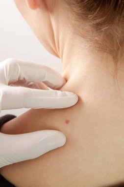 Dermatolog büyüteçle beni kontrol ediyor.