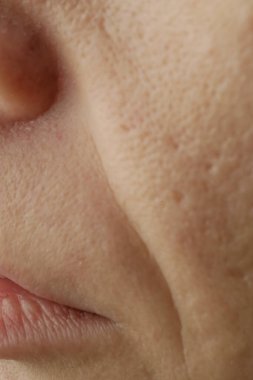 Kadının yüzüne yakın büyük gözenekleri, kızarıklığı ve sivilcesi olan sorunlu hassas bir cilt. 