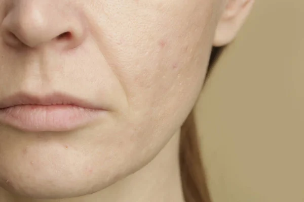 Close Rosto Feminino Pele Sensível Problemático Com Grandes Poros Vermelhidão — Fotografia de Stock