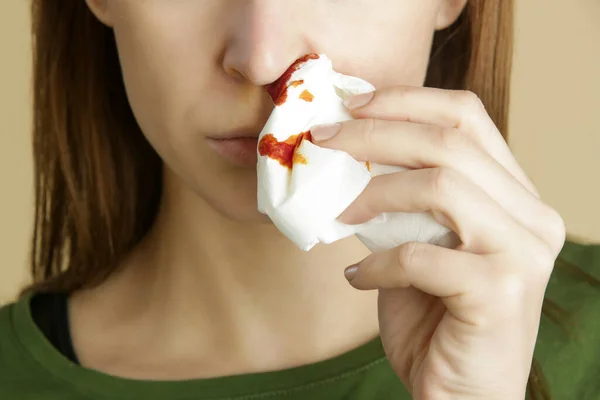 鼻出血 一个年轻的女人有一个血淋淋的鼻子 卫生保健和医疗概念 关闭工作室图像 — 图库照片