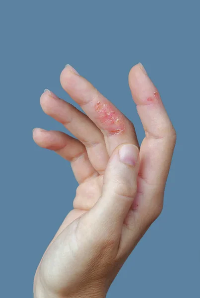 手の皮膚炎 指の湿疹 — ストック写真