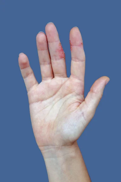 Atopická Dermatitida Rukou Ekzém Prstech — Stock fotografie