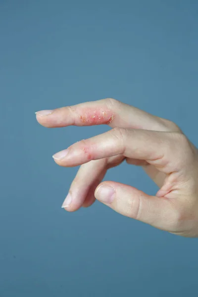 手の皮膚炎 指の湿疹 — ストック写真