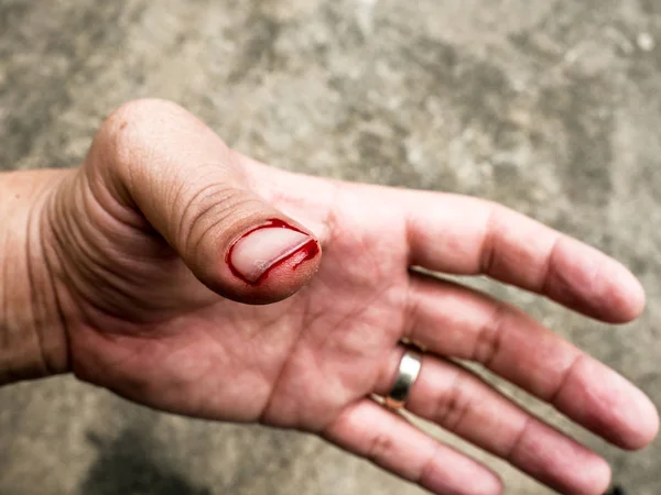 Pulgar izquierdo El flujo sanguíneo causado por la estimación no debe ser c — Foto de Stock