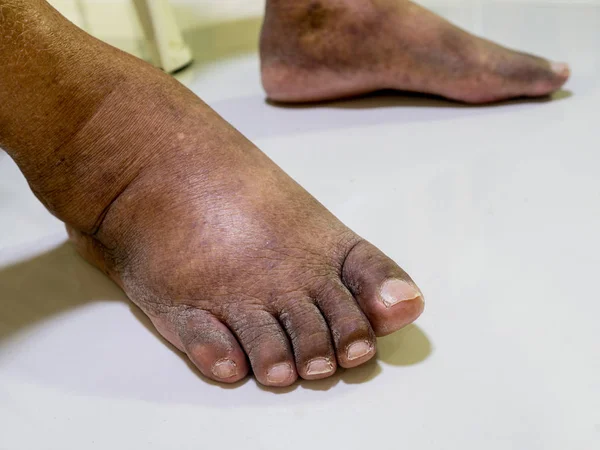 Los pies de las personas con diabetes, aburridos e hinchados . — Foto de Stock