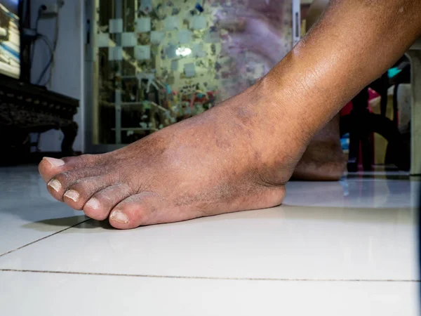 Personer med diabetes, tråkig och svullna fötter. På grund av toxiciteten av diabetes. — Stockfoto