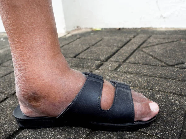 Les pieds de l'homme diabétique, ternes et gonflés. En raison de la toxicité du diabète . — Photo
