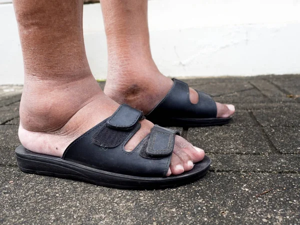 Los pies del hombre con diabetes, aburridos e hinchados. Debido a la toxicidad de la diabetes . — Foto de Stock