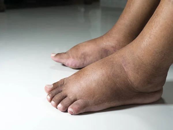 Feet People Diabetes Dull Swollen Due Toxicity Diabetes Placed White — Stock Photo, Image