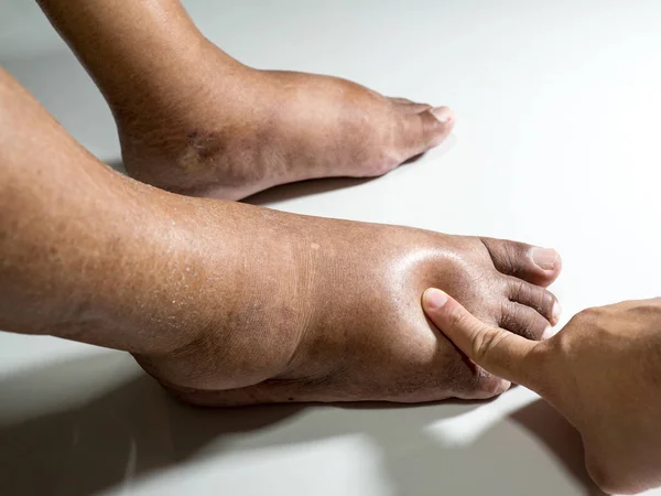 Nohy Lidí Diabetem Nudné Oteklé Vzhledem Toxicitě Diabetu Bílém Pozadí — Stock fotografie