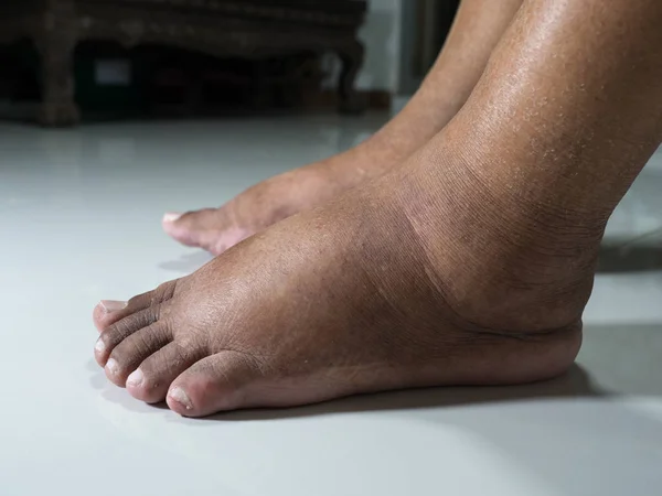 Los Pies Las Personas Con Diabetes Aburridos Hinchados Debido Toxicidad — Foto de Stock