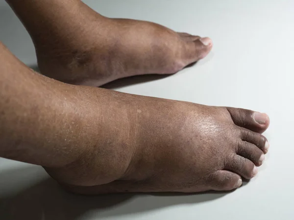 Şeker Hastası Insanların Ayakları Donuk Şişmiş Beyaz Bir Zemin Üzerine — Stok fotoğraf