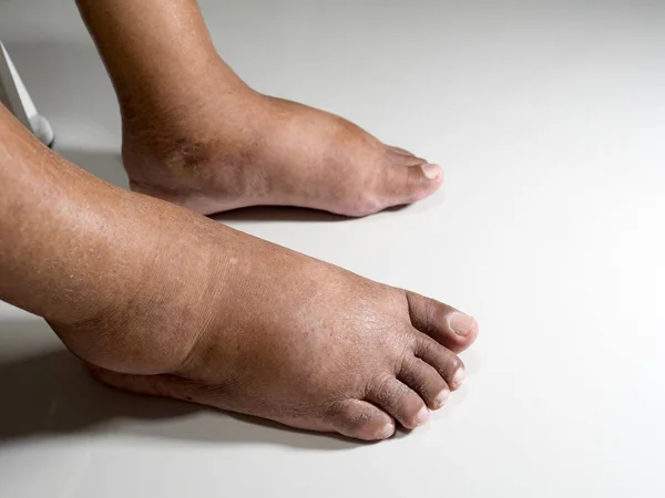 Feet People Diabetes Dull Swollen Due Toxicity Diabetes Placed White — Stock Photo, Image