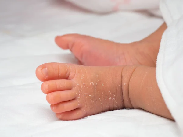 Closeup Instep Foot Newborn Skin Peeling White Cloth Skin Allergies — Stock Photo, Image