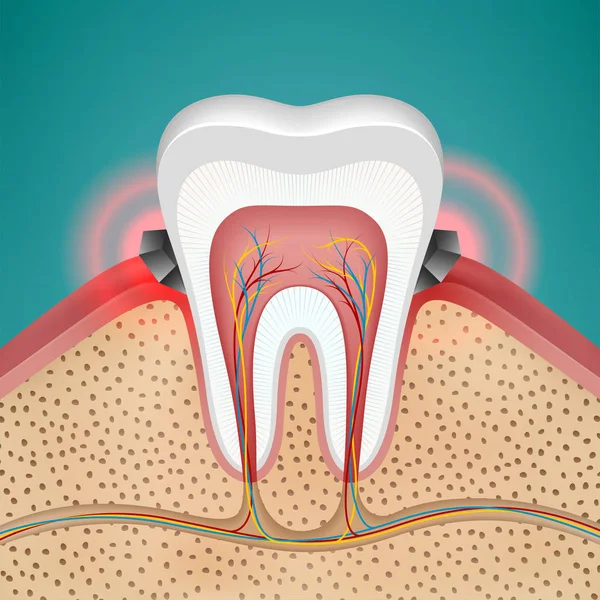 Gingivitis begint op menselijke tand — Stockvector