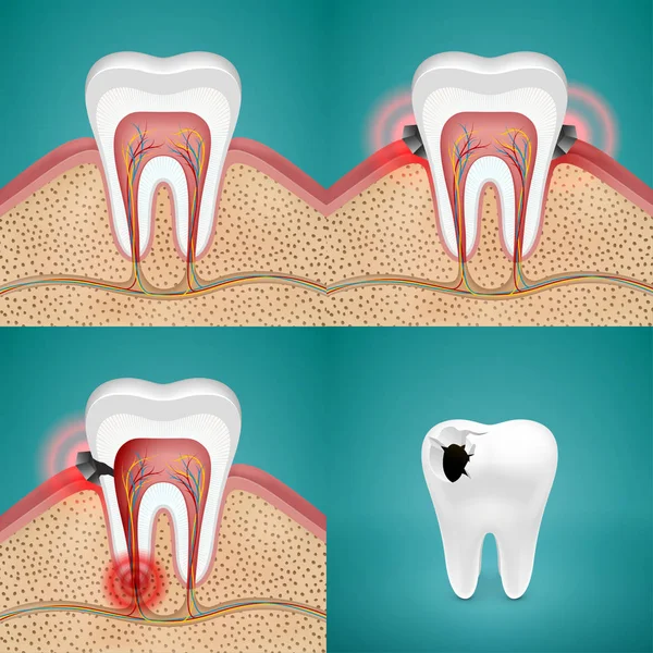 Conjunto de ícones com cárie em dentes humanos — Vetor de Stock