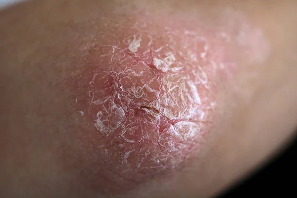 Psoriasis sur le coude vue rapprochée . — Photo