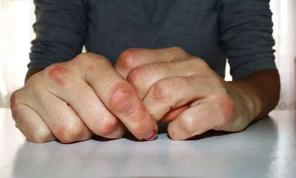 银屑病的手上 红肿和刺激引起银屑病或湿疹的手指上 图库照片