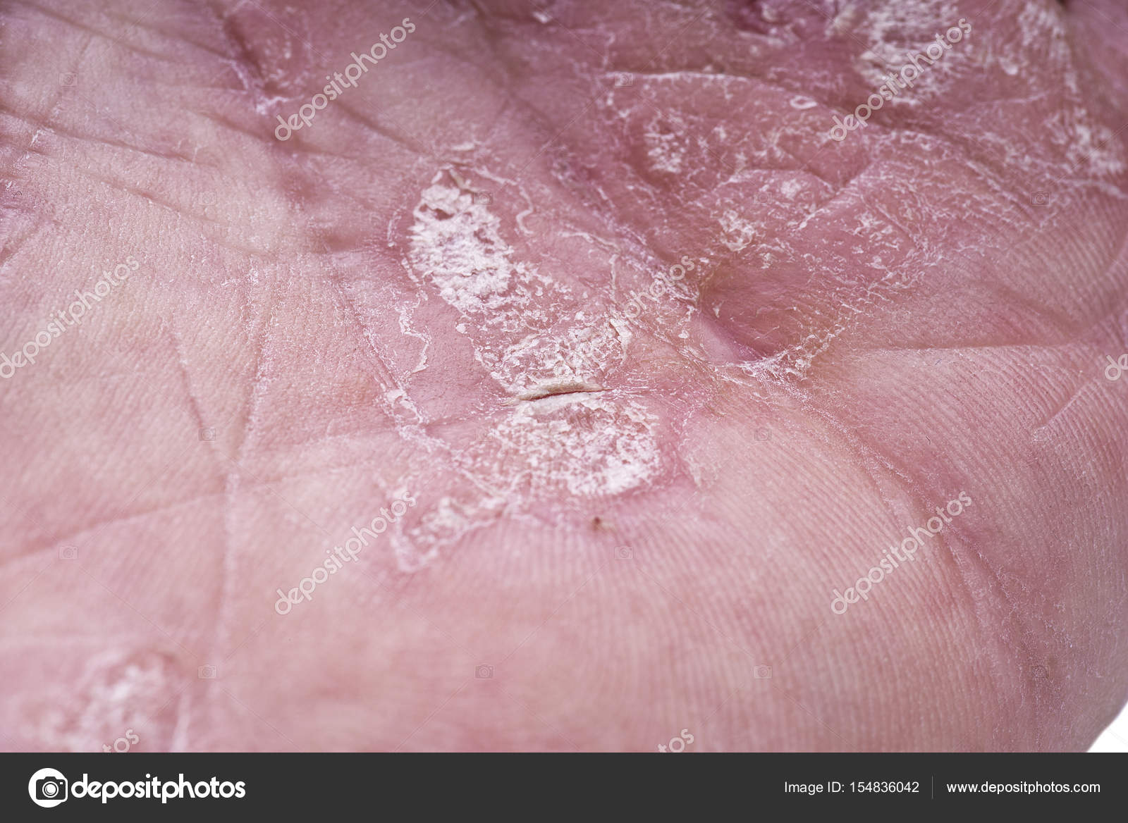 Psoriasis Skin Disease Stock Photo By ©orlandob 154836042
