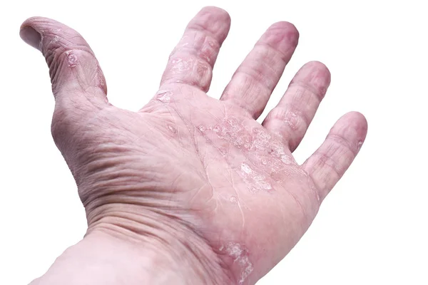 Psoríase, doença da pele — Fotografia de Stock