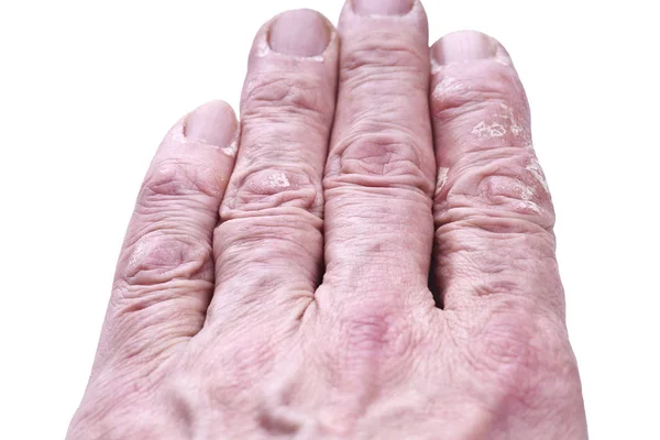 Psoriasis, skin disease — Stock Photo, Image