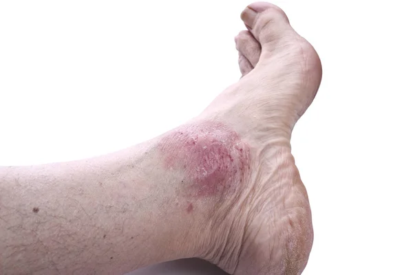 Psoriasis, hudsjukdom — Stockfoto