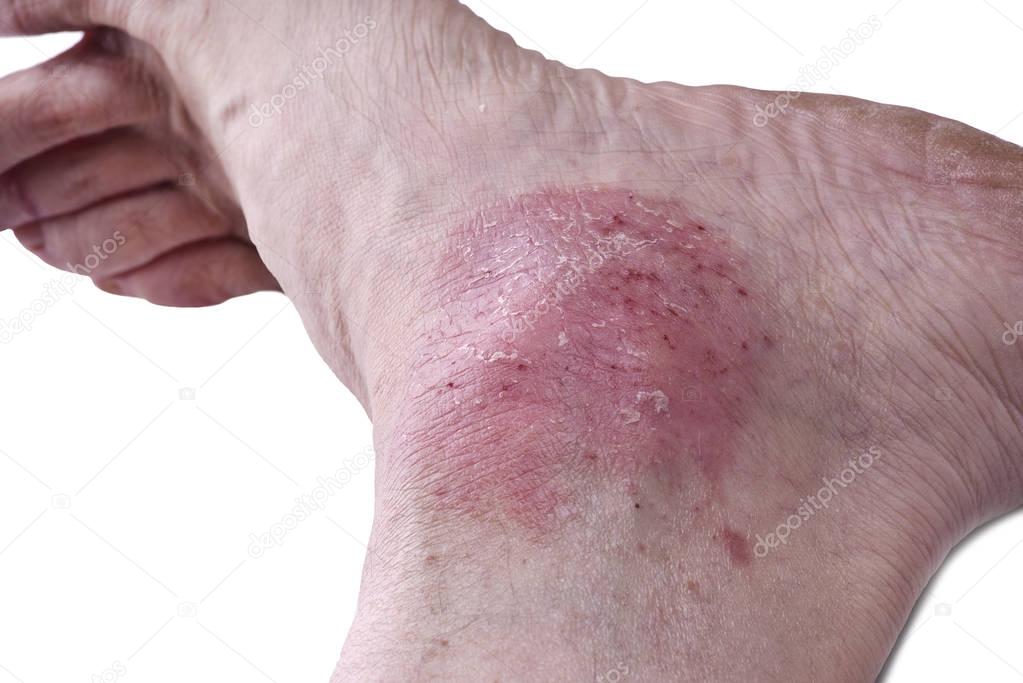 Psoriasis, skin disease