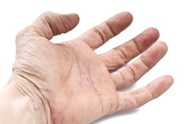 Sedef hastalığı, deri hastalığı vücudun eklemler üzerinde