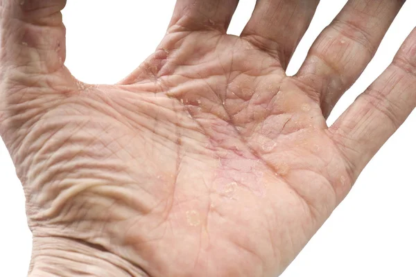 Psoriasis Skin Disease Joints Body — Stock Photo, Image