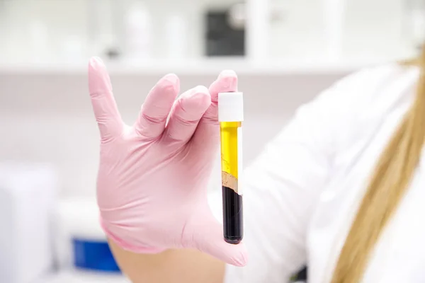 Hemşire eldiveni içinde, üzerinde kan ve güzellik prosedürü için plazma olan test tüpü tutuyor.
