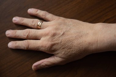 Çillerle ve kırışıklıklarla dolu yaşlı kadın elleri. Yaşlanma kavramı