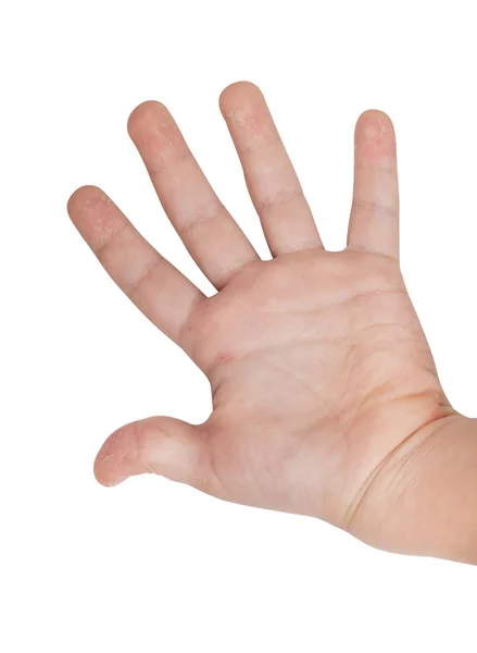 La main d'un enfant atteint de scarlatine. Le stade initial de l'exfoliation de la peau — Photo