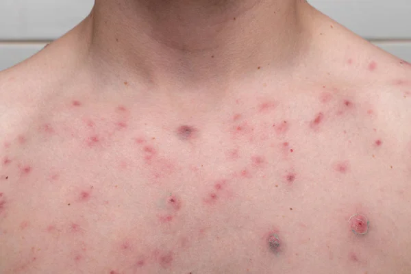 Acne Petto Maschile Risultato Dell Uso Steroidi Anabolizzanti Fotografia Stock