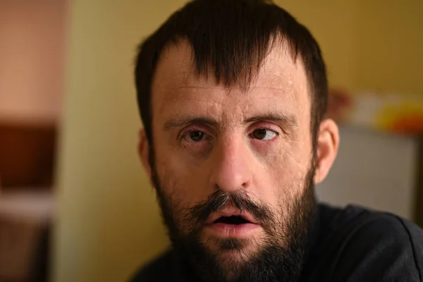 Porträtt Man Med Downs Syndrom — Stockfoto