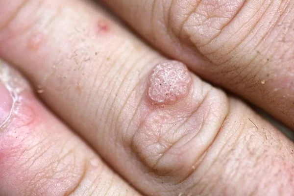 Wart Hand Finger Close — Stock Photo, Image