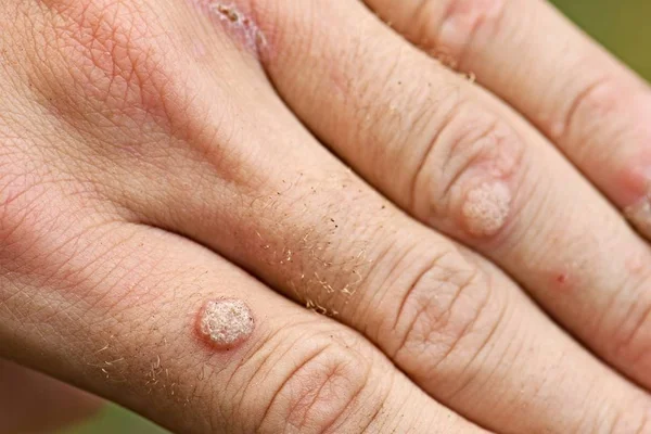 Warts Hand Fingers Close — Stock Photo, Image