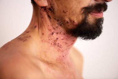 man with shingles virus clipart