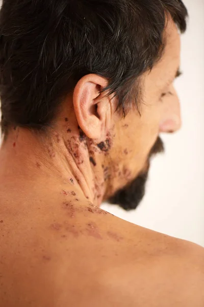 Hombre Con Virus Culebrilla — Foto de Stock