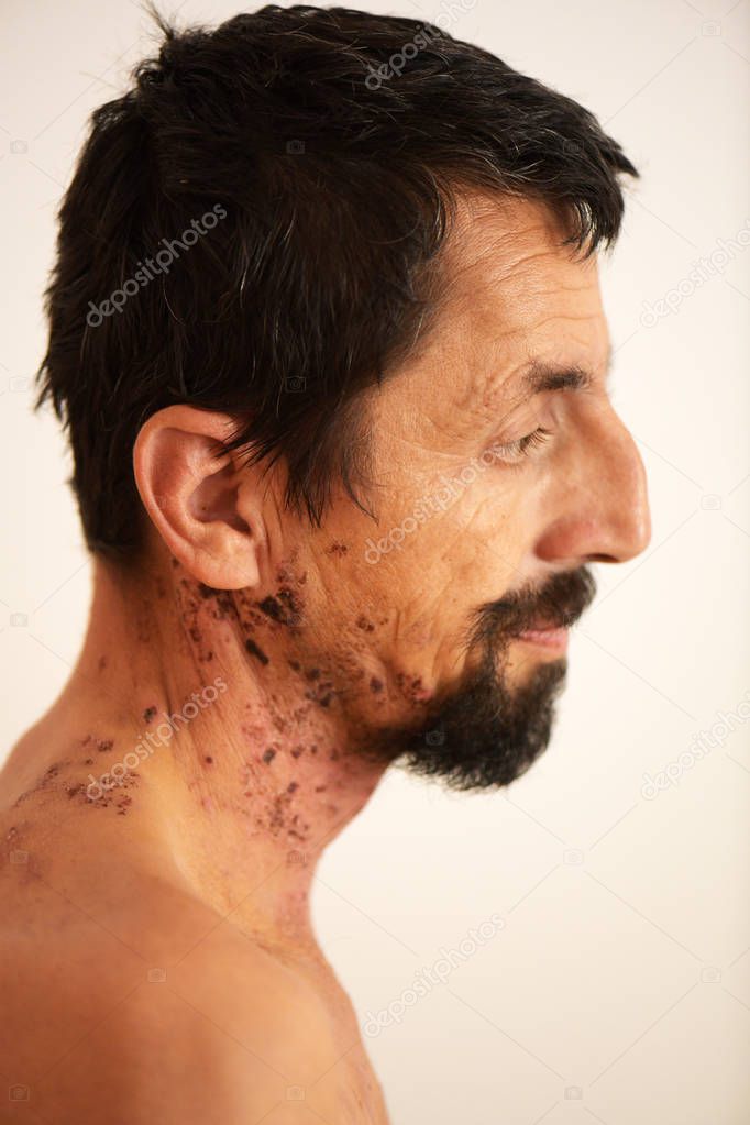 man with shingles virus