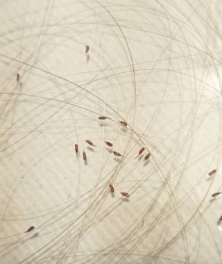 Baş bitleri (louses) izole edildi