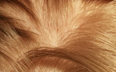 Close up of louses in human hair 