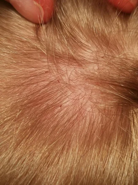 Close Louses Human Hair — Foto Stock