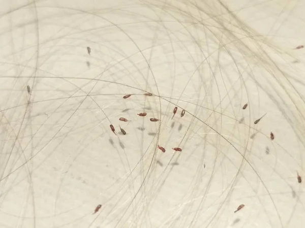 Head Lice Louses Isolated — Photo