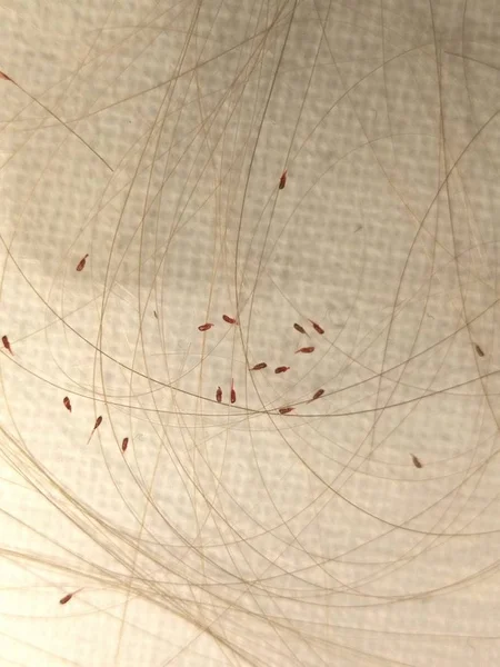 Head Lice Louses Isolated — Stok fotoğraf