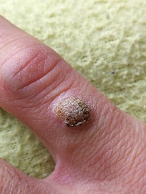 Parmağında siğil var, kapat.