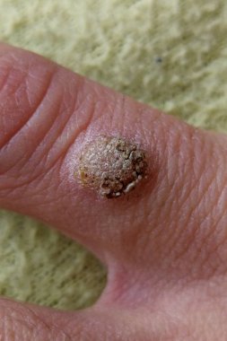 Parmağında siğil var, kapat.