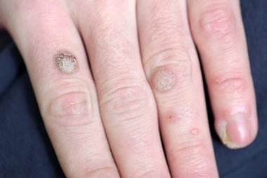 Warts on the hand finger, close up clipart