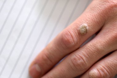 Warts on the hand finger, close up clipart