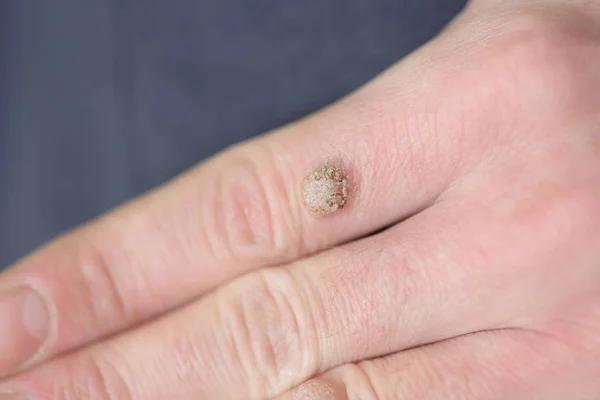 Warts Hand Finger Close — Stock Photo, Image